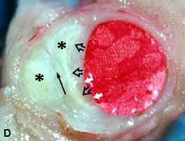 Figure 7. A - C, Coronary section from the proximal LAD of a 74-year-old white male.