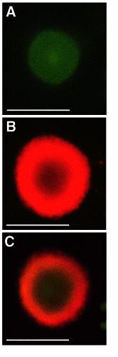 Lewy bodies visualized by staining for ubiquitin.