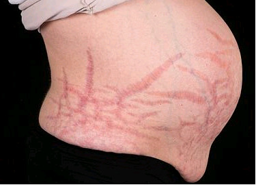 Figure 1. . The wide purple striae on the abdominal wall due to Cushing’s syndrome (permission of the patient obtained).