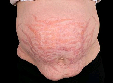 Figure 1. . The wide purple striae on the abdominal wall due to Cushing’s syndrome (permission of the patient obtained).