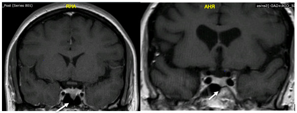 Figure 2. . Magnetic resonance scan of the head with gadolinium showing left-sided pituitary hypointense microadenoma (white arrows) in 2 different patients (T1 image post-contrast).