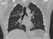 Allergic Bronchopulmonary Aspergillosis on CT Scan