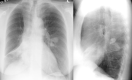 A Chest Radiograph Depicting Asthma