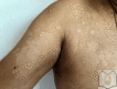 Pityriasis Versicolor Contributed by Dr