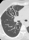 CT Scan, COPD, Chronic Obstructive Pulmonary Disease, ABPA, Allergic Bronchopulmonary Aspergillosis Contributed by chestatlas