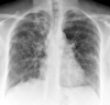 X-ray, COPD, Chronic Obstructive Pulmonary Disease, ABPA, Allergic bronchopulmonary aspergillosis, Poster Anterior, Contributed by chestatlas