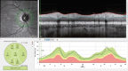 Fig. 3.15. Nerve fiber layer thickness analysis: Three peripapillary circular sans are placed at the optic nerve head with a fixed starting point relative to the macula position (top left inset) and in each circle scan the RNFL and ILM are segmented (top right inset).