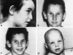 Figure 1. The four Italian patients affected by trichothiodystrophy, firstly described as NER-defective and classified into the XP-D group.