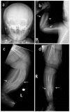 Figure 1. . Skeletal survey in a female age five weeks with COL1A1 pathogenic variant p.