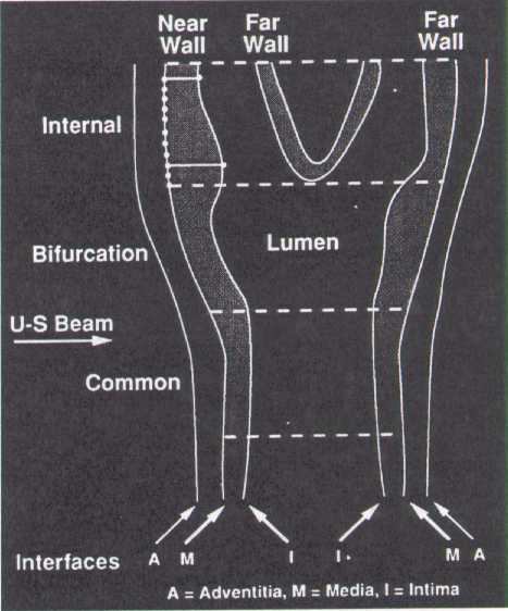 Schematic Overview of Carotid Artery B-Mode Ultrasound Measurements